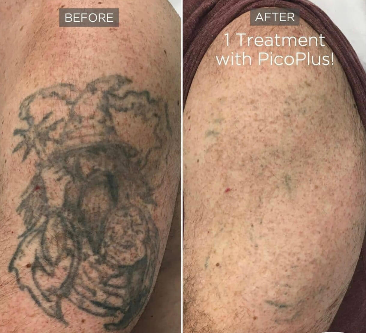 doctor chantes tattoo removal