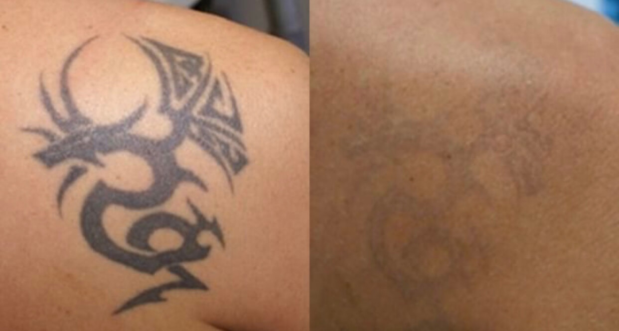 Clinics - Remove Your Tattoo