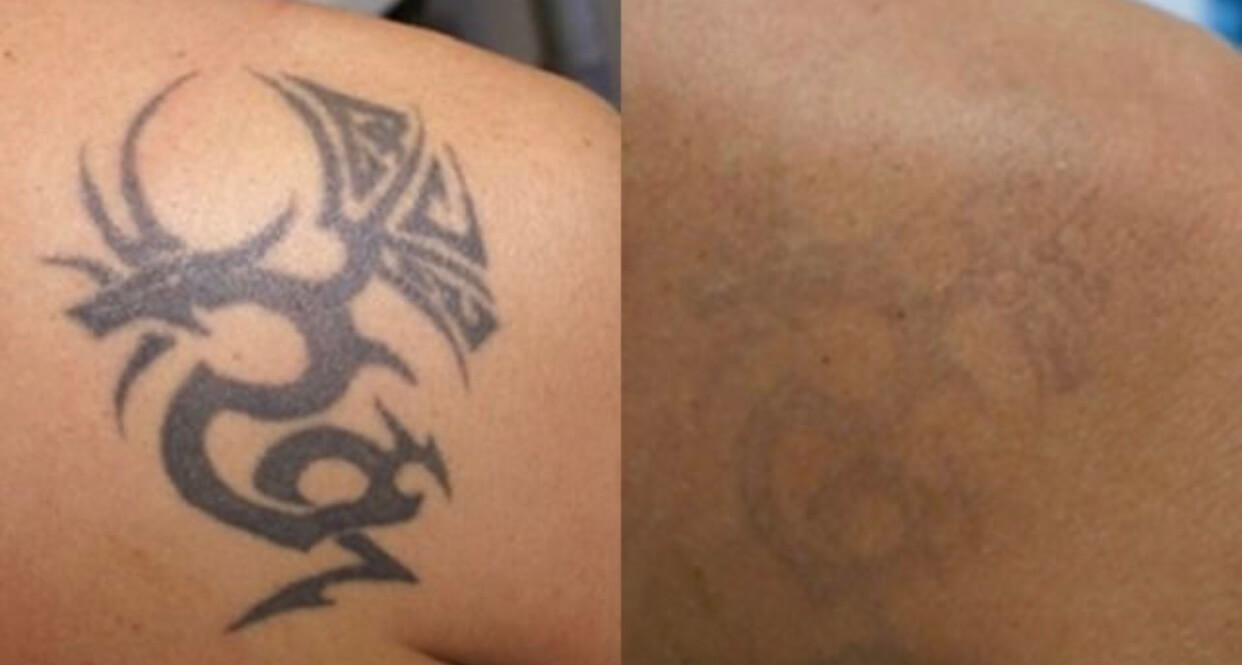 doctor chantes tattoo removal