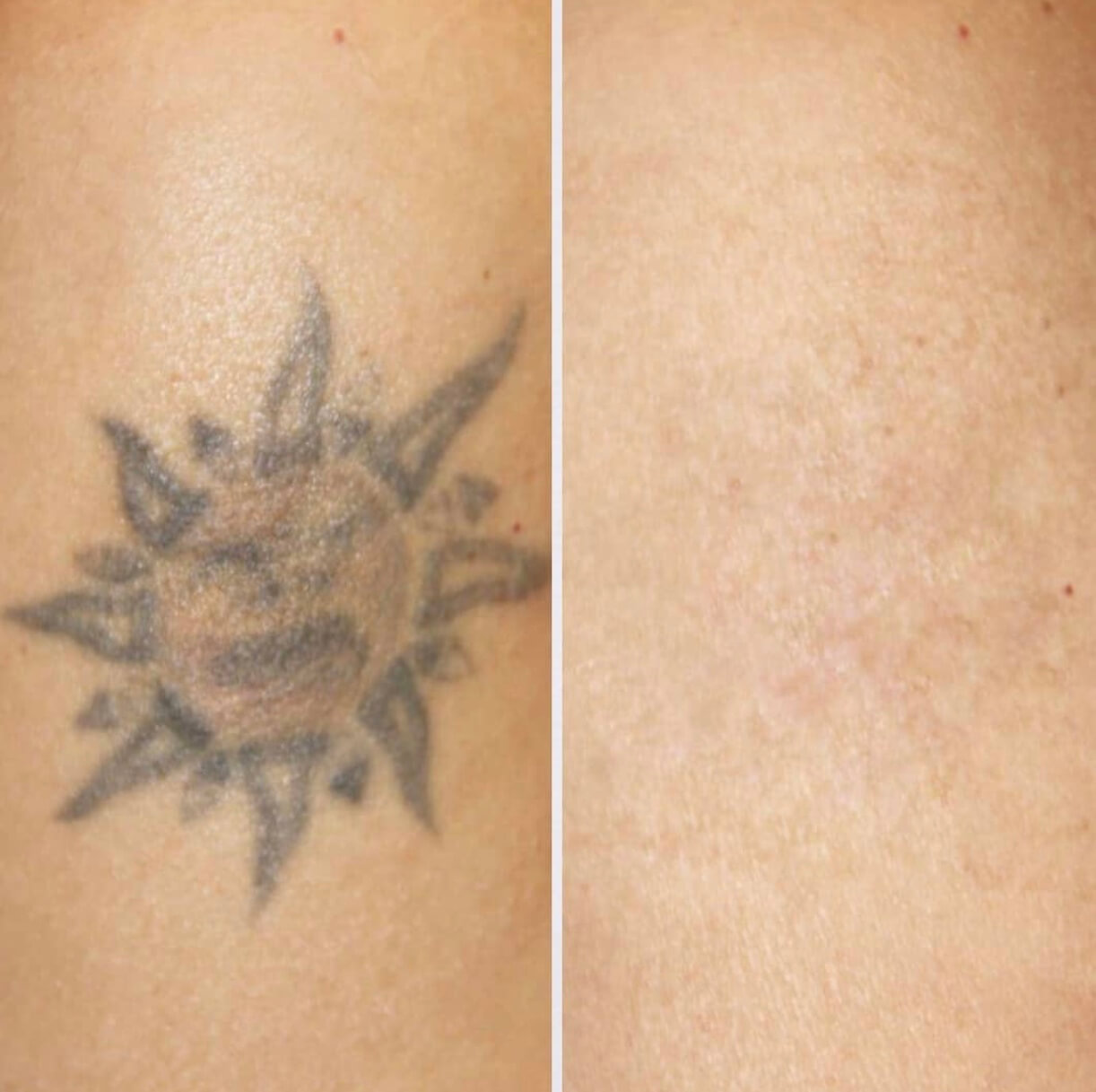 doctor chantes tattoo removal