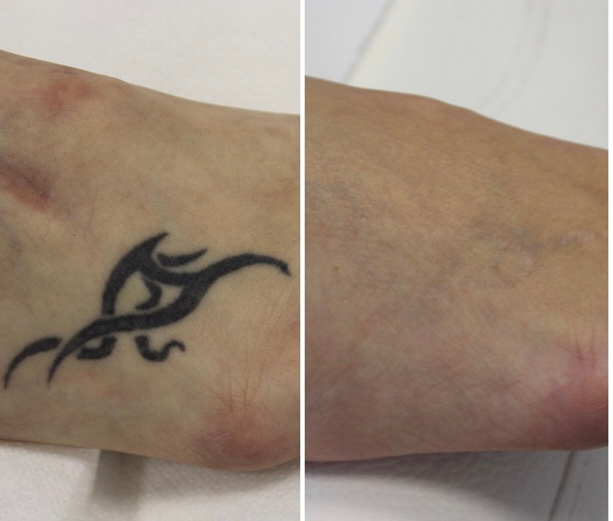 doctor chantes tattoo removal