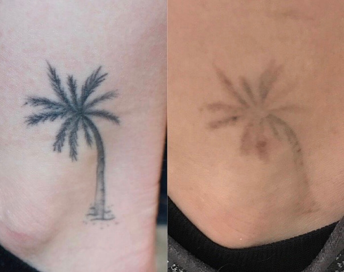 doctor chantes tattoo removal