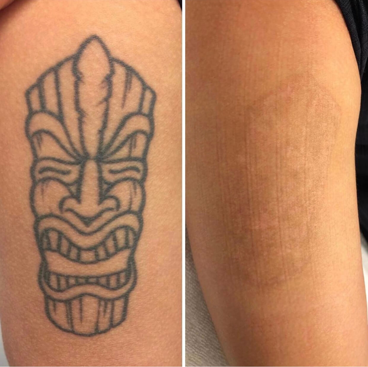 doctor chantes tattoo removal