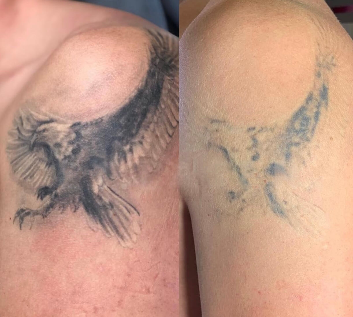 doctor chantes tattoo removal